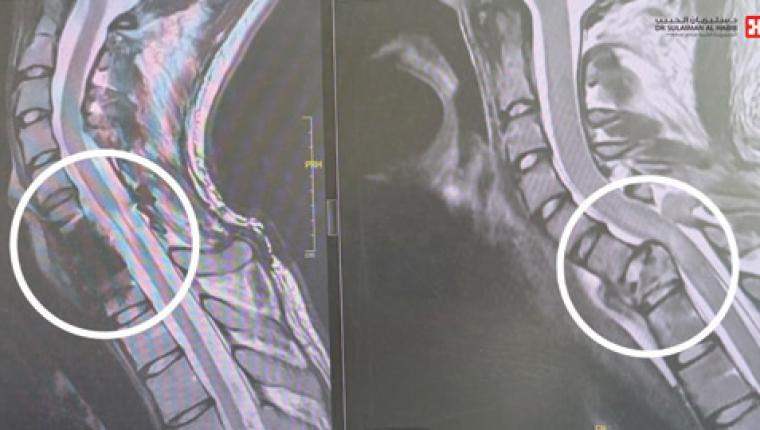 مستشفى الدكتور سليمان الحبيب بالقصيم ينقذ شاباً من الشلل المحتم