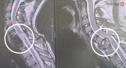 مستشفى الدكتور سليمان الحبيب بالقصيم ينقذ شاباً من الشلل المحتم